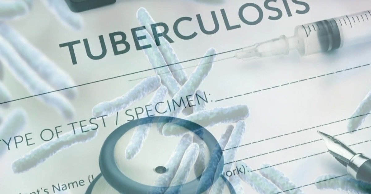 Tuberculosis outbreak reported in Kansas