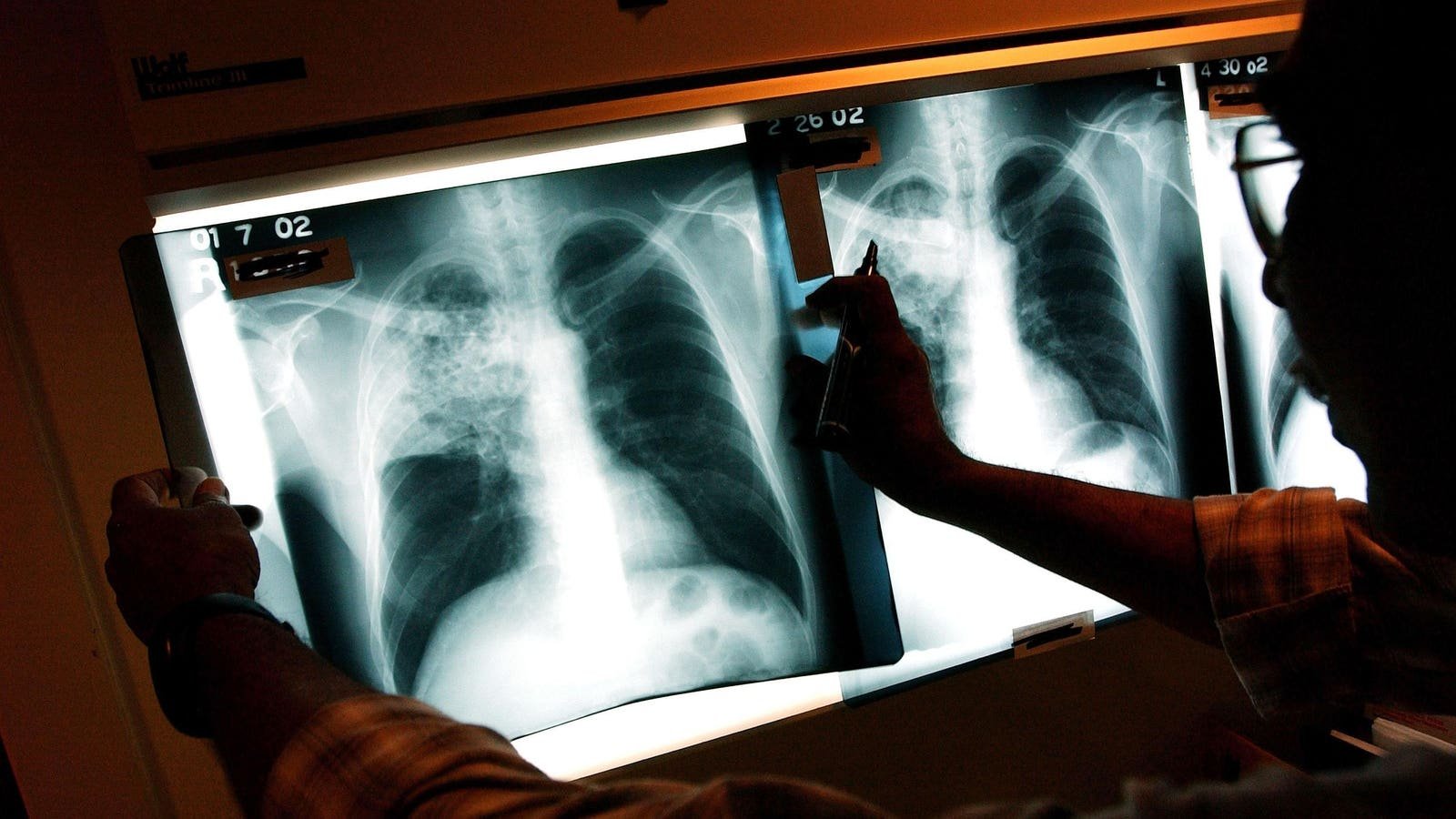 What To Know About The Kansas Tuberculosis Outbreak