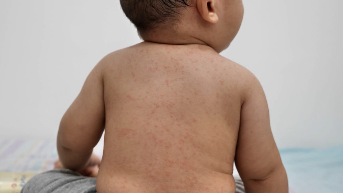 Michigan's 1st measles case of 2025 exposed others in Rochester