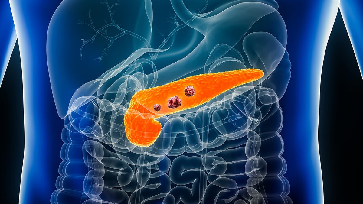 Pancreatic cancer 3d rendering