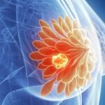 Chemotherapy Linked to Persistent Physical Health Decline in Breast Cancer Survivors