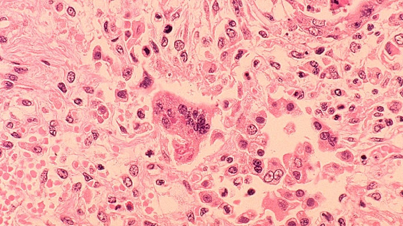 Health officials across DMV issue exposure warnings after 2 confirmed cases of measles