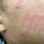 The shaky science behind treating measles with vitamin A